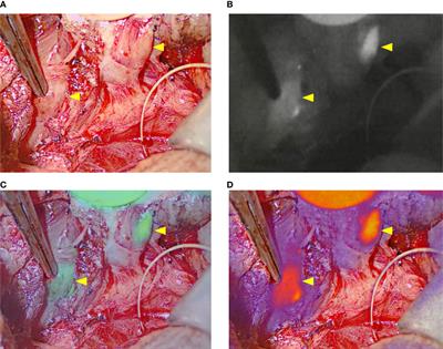 Preliminary experience with the EleVision IR system in detection of parathyroid glands autofluorescence and perfusion assessment with ICG